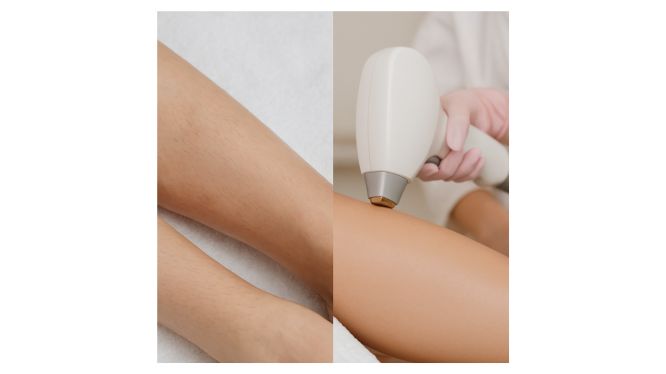 Laserhaarentfernung in Hanau: Mythen, Fehler und häufige Irrtümer – was stimmt wirklich?