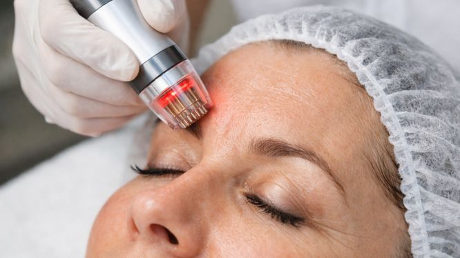 RF Needling für Stirn & Augen: Sanfte Lösung gegen feine Falten ohne OP